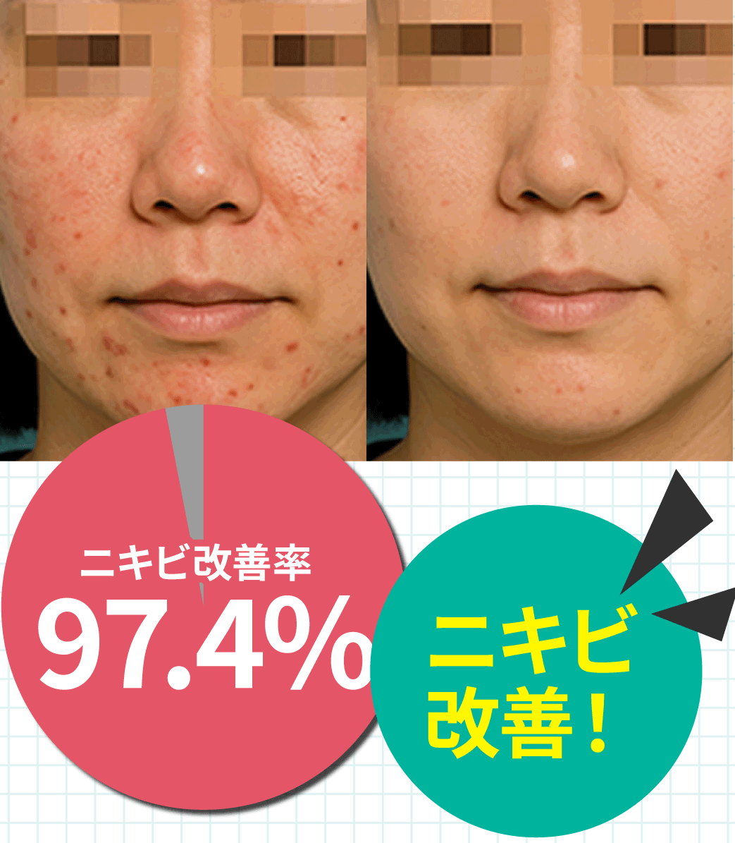 ニキビ改善率97.4%！